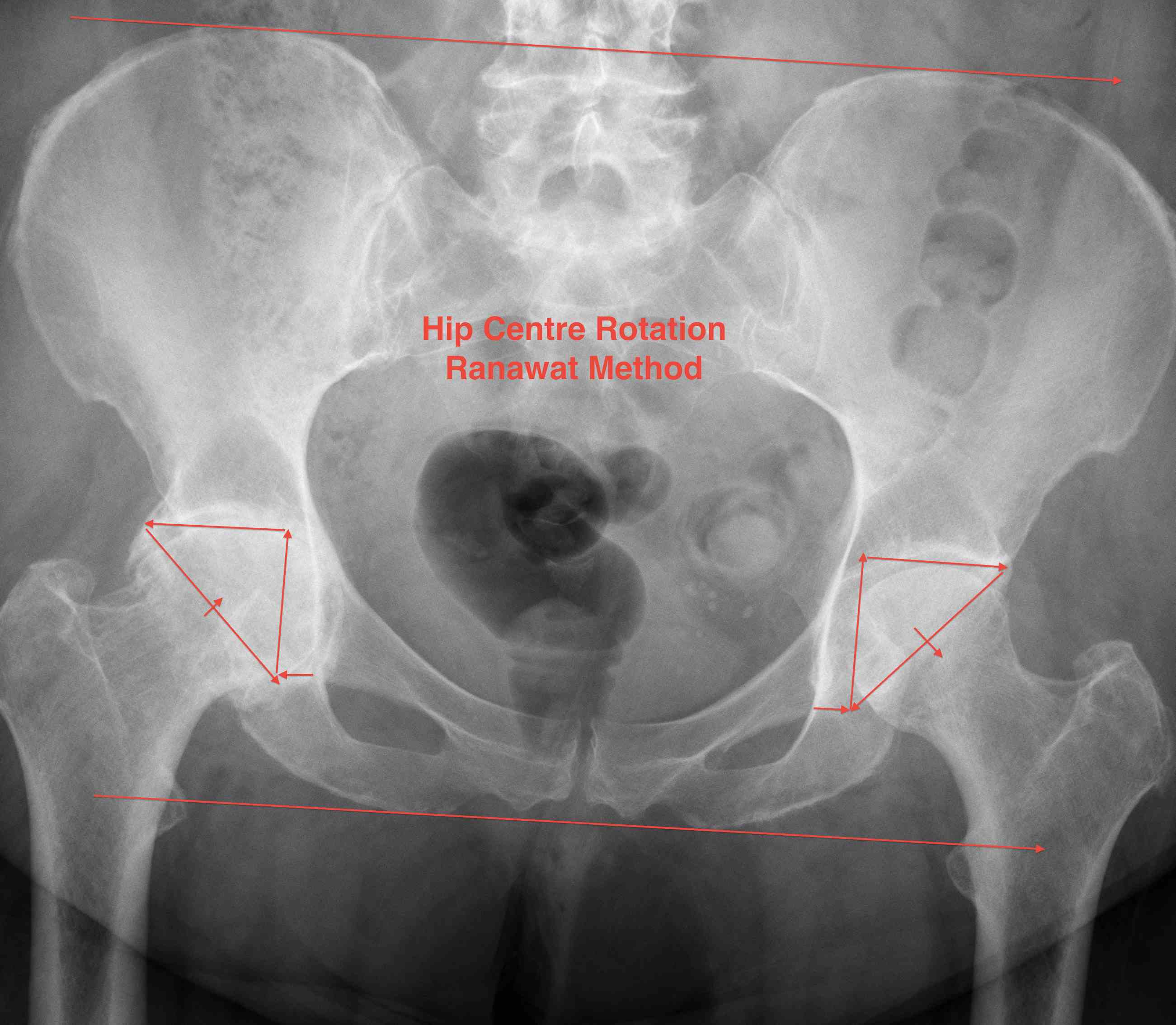 Centre of Rotation Ranawat Method